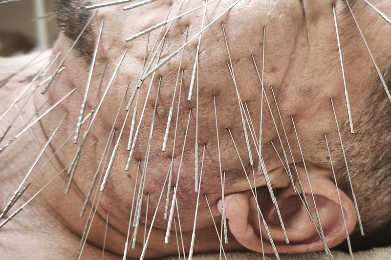 鹿児島市 眼精疲労 頭痛 鍼灸｜顔への施術｜きやま鍼灸治療院