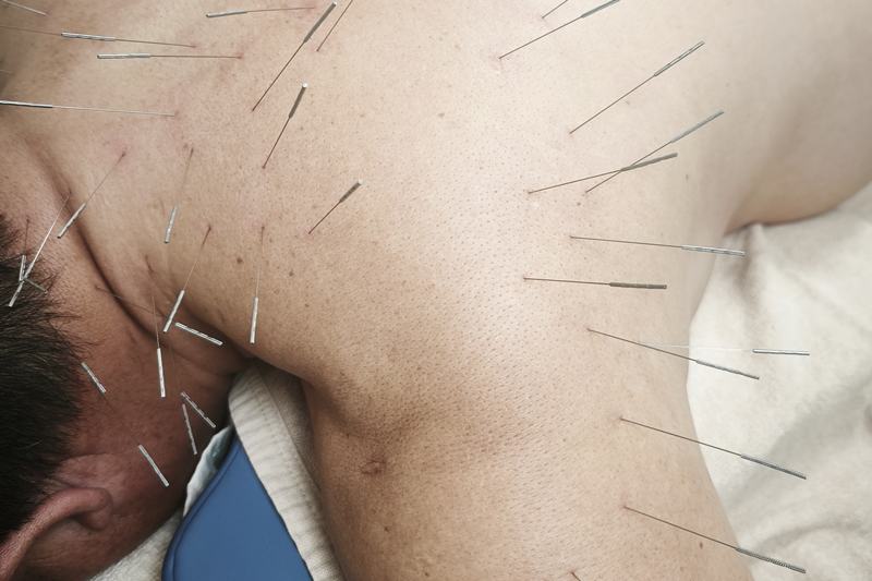 鹿児島市 背中 痛み 鍼灸｜首・肩への施術（別角度）｜きやま鍼灸治療院