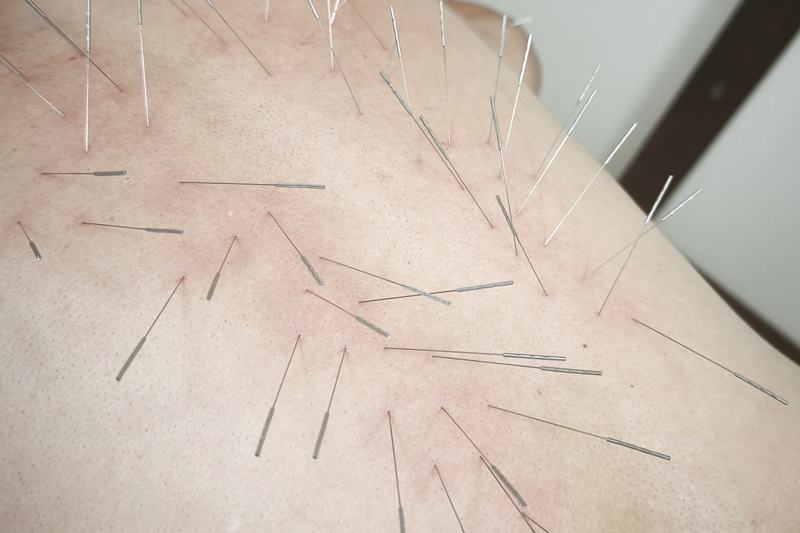 鹿児島市 背中 痛み 鍼灸｜背中へのルート治療｜きやま鍼灸治療院