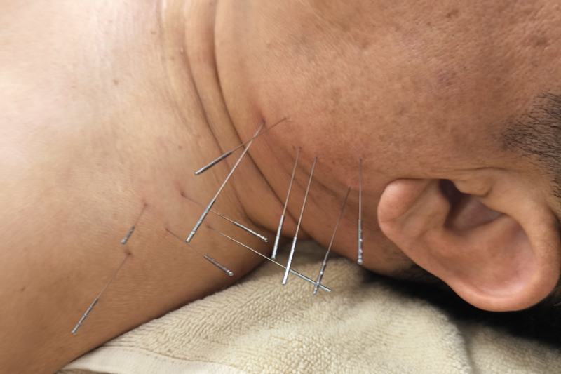 鹿児島市 背中 痛み 鍼灸｜前頚部へのルート治療｜きやま鍼灸治療院