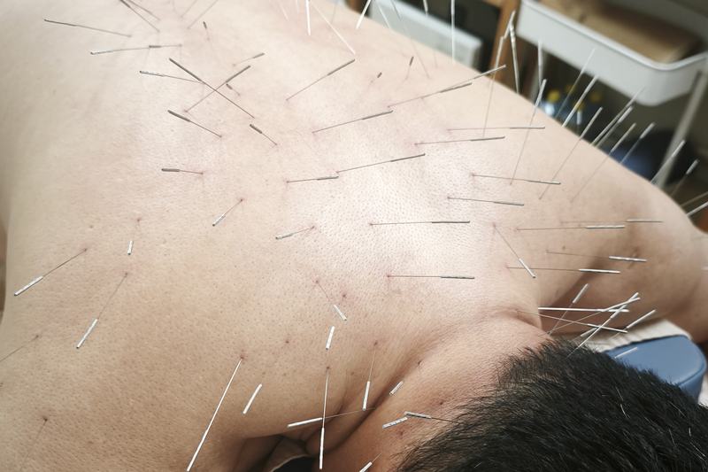 鹿児島市 背中 痛み 鍼灸｜首・肩へのルート治療｜きやま鍼灸治療院