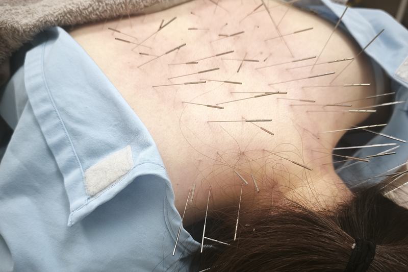 鹿児島市 肩甲骨 激痛 鍼灸｜首・肩へのルート治療｜きやま鍼灸治療院