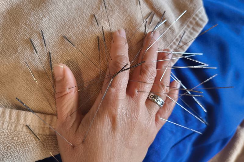 宮崎 全身の不調 鍼灸｜指へのルート治療｜きやま鍼灸治療院