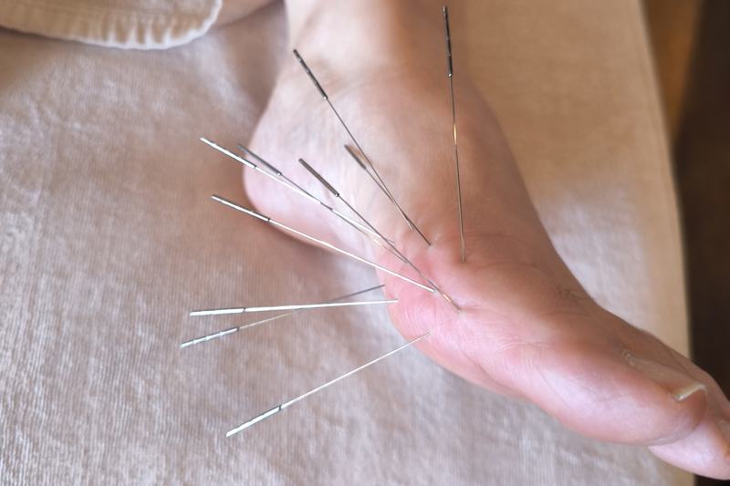 宮崎 全身の不調 鍼灸｜外反母趾へのルート治療｜きやま鍼灸治療院