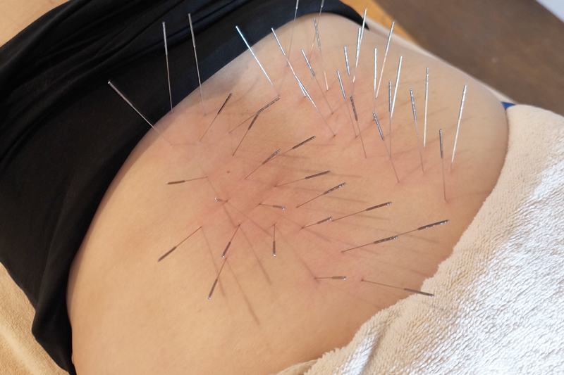 宮崎 全身の不調 鍼灸｜腰へのルート治療｜きやま鍼灸治療院