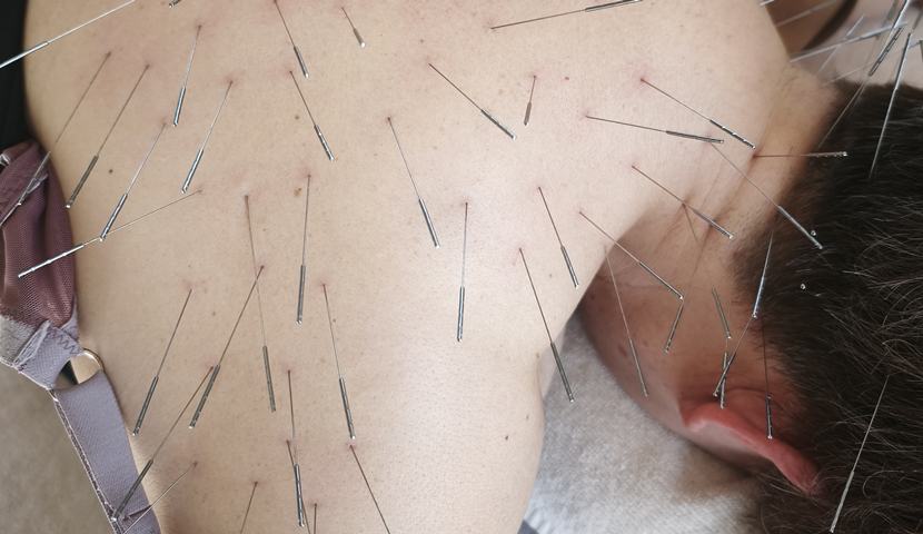 宮崎 全身の不調 鍼灸｜首・肩へのルート治療｜きやま鍼灸治療院