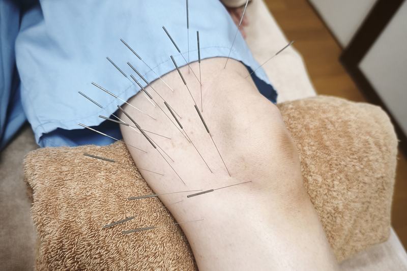 薩摩川内 ぎっくり腰 鍼灸｜膝へのルート治療｜きやま鍼灸治療院
