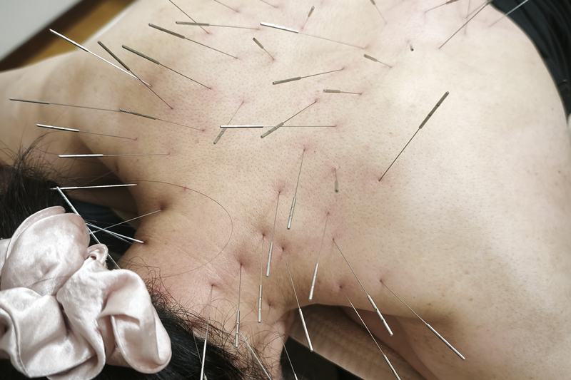 薩摩川内 ぎっくり腰 鍼灸｜首・肩へのルート治療｜きやま鍼灸治療院