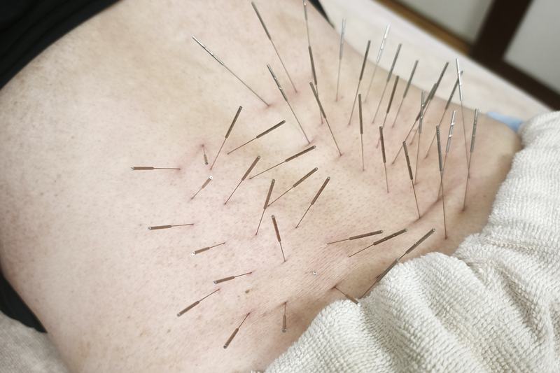 薩摩川内 ぎっくり腰 鍼灸｜腰へのルート治療｜きやま鍼灸治療院