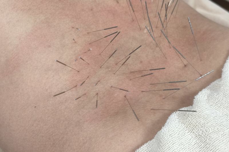 鹿児島市 鍼灸 怖い|腰へのルート治療の様子|きやま鍼灸治療院