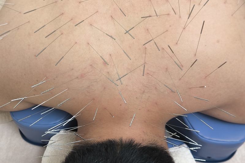 鹿児島市 鍼灸 怖い|首・肩へのルート治療の様子|きやま鍼灸治療院