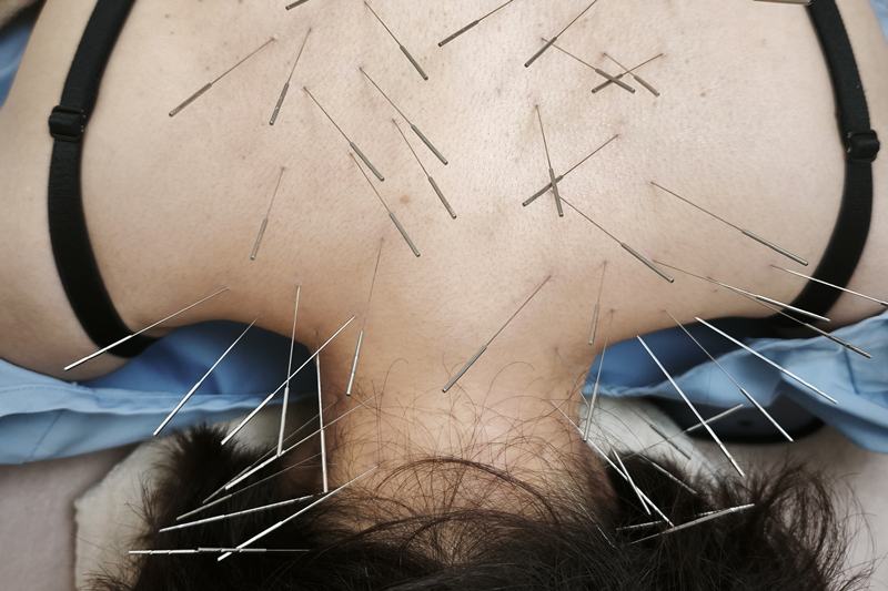 鹿児島市 急性腰痛 鍼灸｜首・肩へのルート治療｜きやま鍼灸治療院