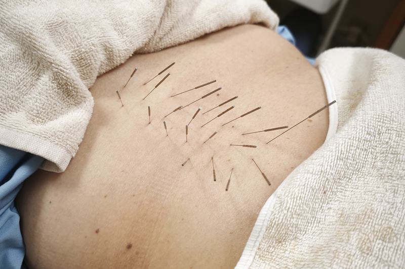 鹿児島市 急性腰痛 鍼灸｜腰へのルート治療｜きやま鍼灸治療院