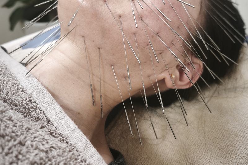 鹿児島市 慢性疲労 鍼灸｜顔へのルート治療｜きやま鍼灸治療院