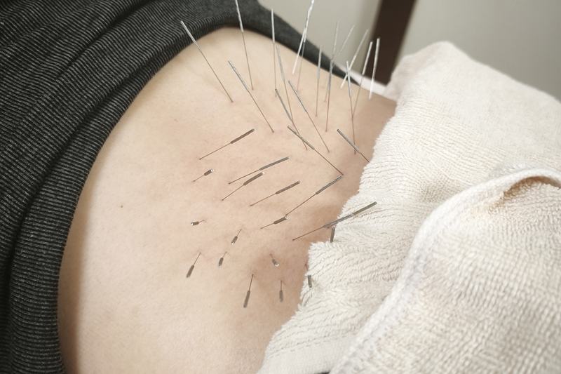 鹿児島市 慢性疲労 鍼灸｜腰へのルート治療｜きやま鍼灸治療院