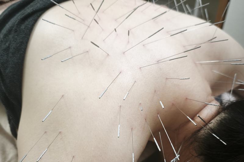 鹿児島市 慢性疲労 鍼灸｜首・肩へのルート治療｜きやま鍼灸治療院