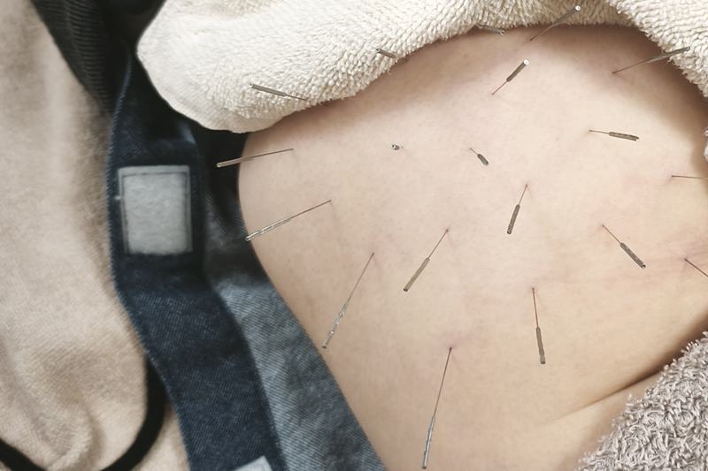 鹿児島市 慢性疲労 鍼灸｜臀部へのルート治療｜きやま鍼灸治療院