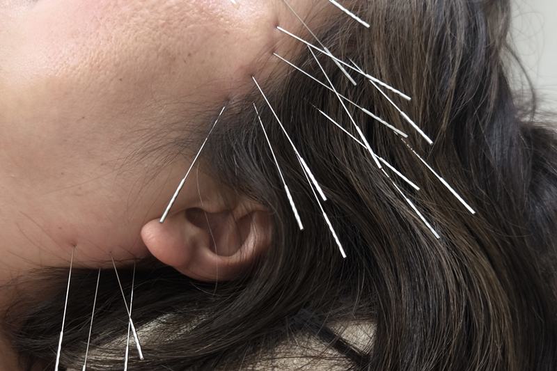 鹿児島市 眼精疲労 鍼灸|こめかみへの施術