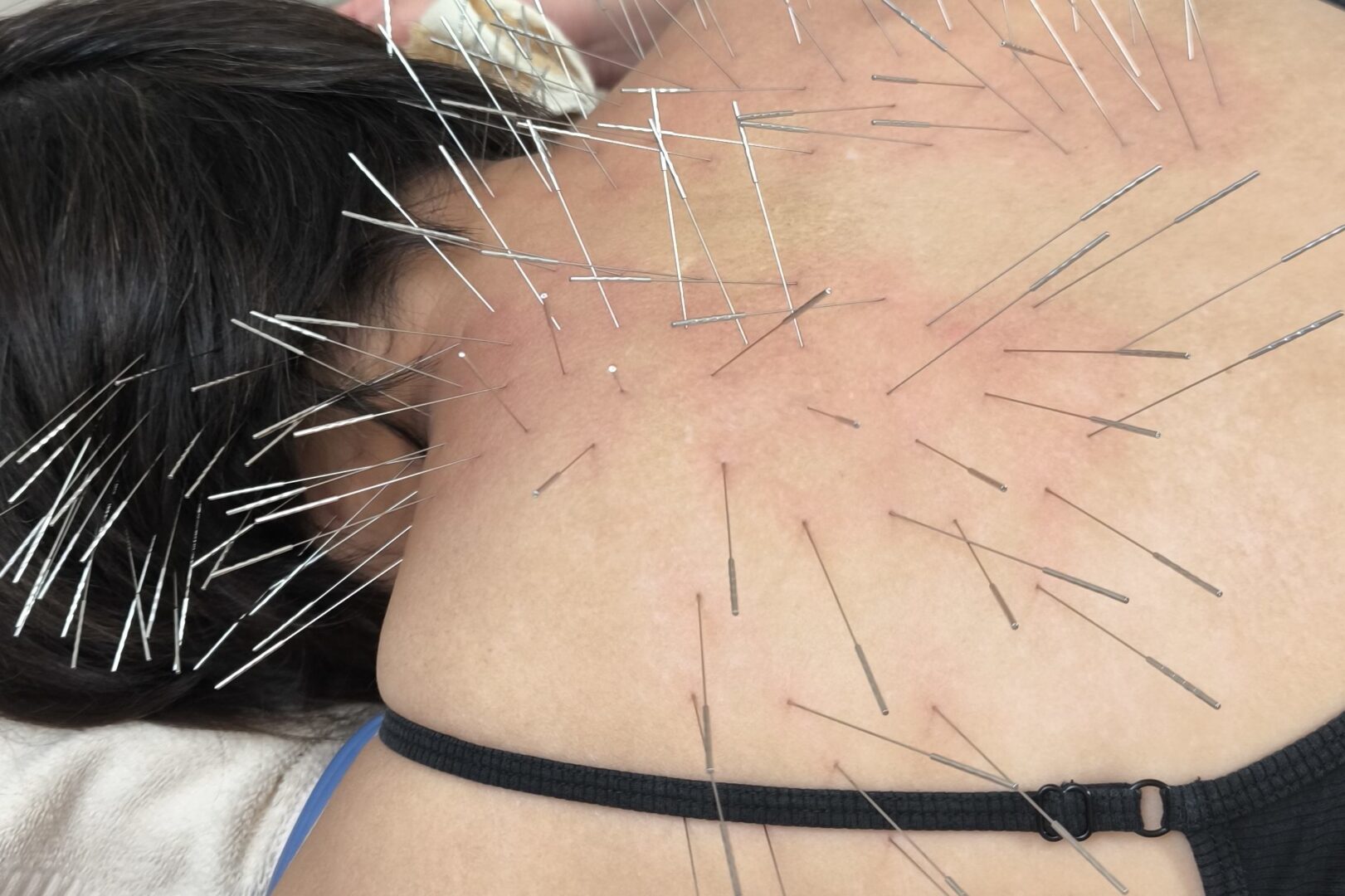 鹿児島市 眼精疲労 鍼灸|首・肩への施術