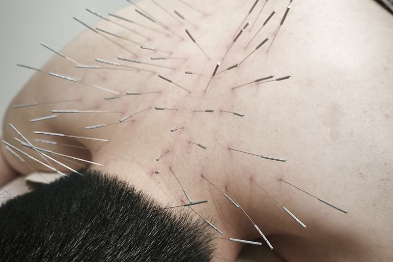 鹿児島市 寝違え 鍼灸｜首・背中へのルート治療｜きやま鍼灸治療院