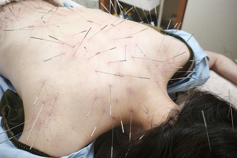鹿児島市 捻挫 鍼灸|首・肩へのルート治療|きやま鍼灸治療院