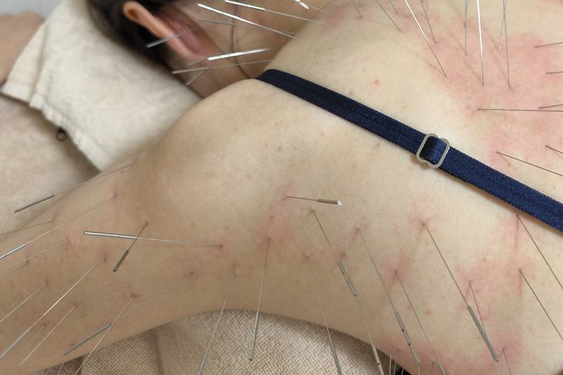 鹿児島市 捻挫 鍼灸|大円筋・広背筋へのルート治療|きやま鍼灸治療院