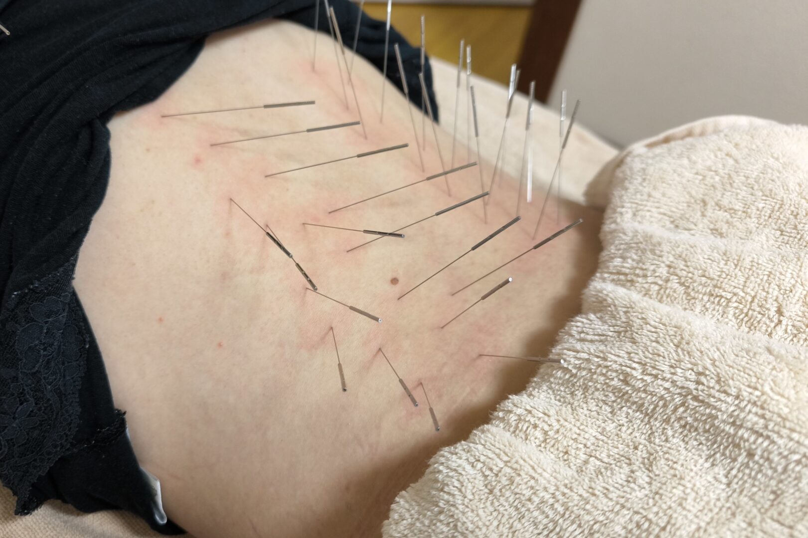 鹿児島市 捻挫 鍼灸|腰へのルート治療|きやま鍼灸治療院