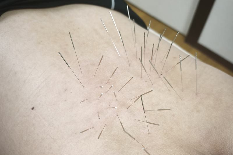 鹿児島 急性腰痛 鍼灸｜ぎっくり腰へのルート治療｜きやま鍼灸治療院