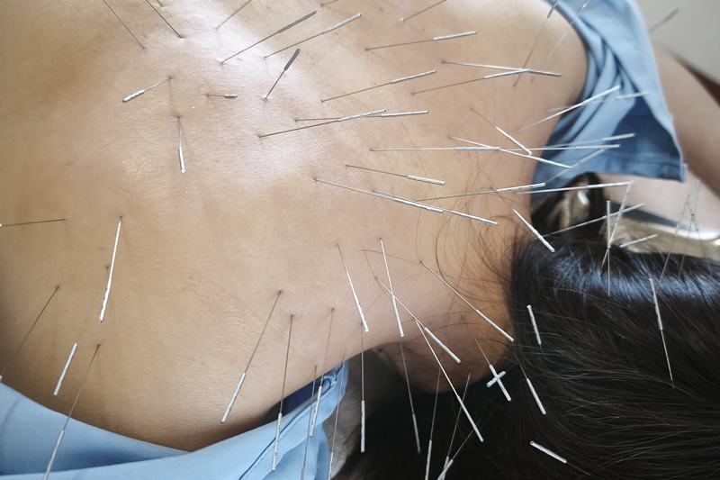 宮崎 ルート治療｜首肩への鍼｜きやま鍼灸治療院